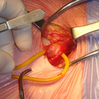 Cirugía de Hernia Inguinal 